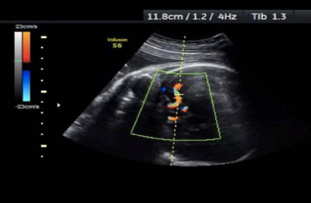 ¿Qué es la anemia fetal?