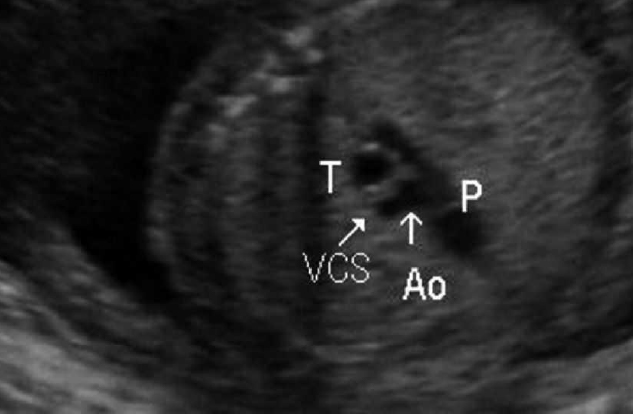 ¿Qué es la espina bífida?