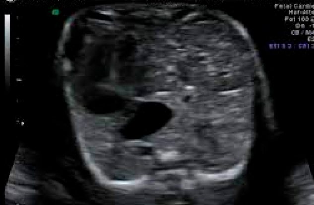 ¿Qué es la hernia diafragmática congénita?